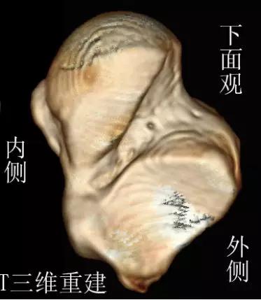 踝关节撞击症问诊,踝关节内侧撞击综合症位置图