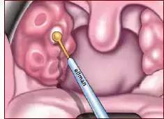 扁桃体总发炎该不该切掉,扁桃体手术要切掉什么结构