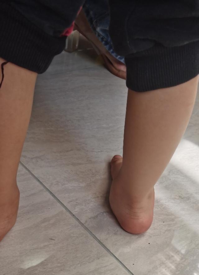 治疗足外翻哪家医院好,什么是足外翻与足内翻