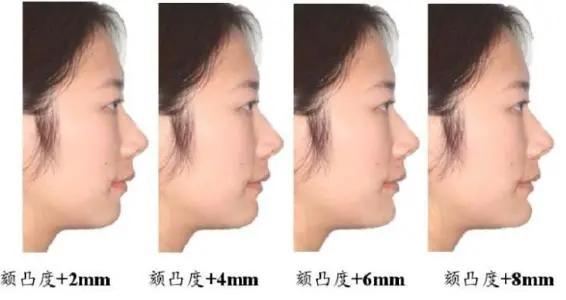 韦敏削骨怎么样,韦敏做peek下巴多少钱