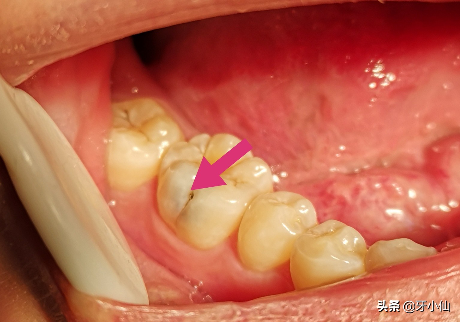 牙太痛,吃不了热辣火锅、冰爽雪糕、酸甜水果,怎么能当吃货?