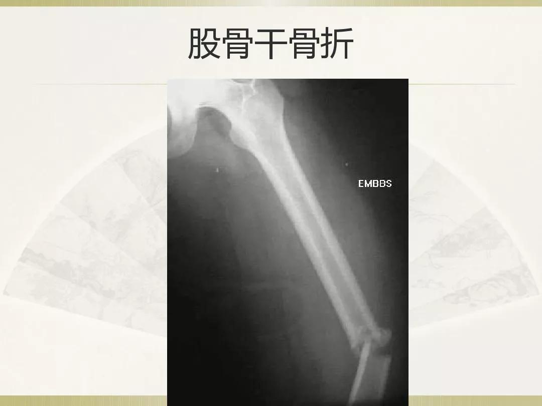 骨科x光片读片技巧,放射科骨科读片教程