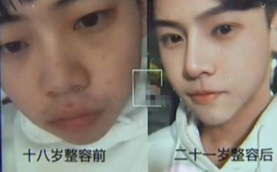 男子整容花十几万完整版,小伙花十几万整容太成功后续