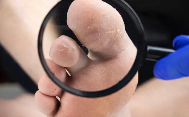 脚气脚怎么修,治疗脚气足癣的方法