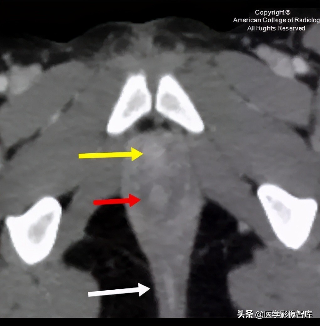 先天性无阴道综合征的影像诊断