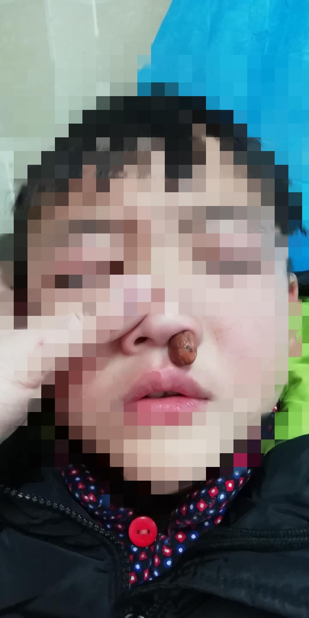 家长注意！徐州多名孩子鼻孔里出现了*珠钢**、西瓜、橡皮泥……