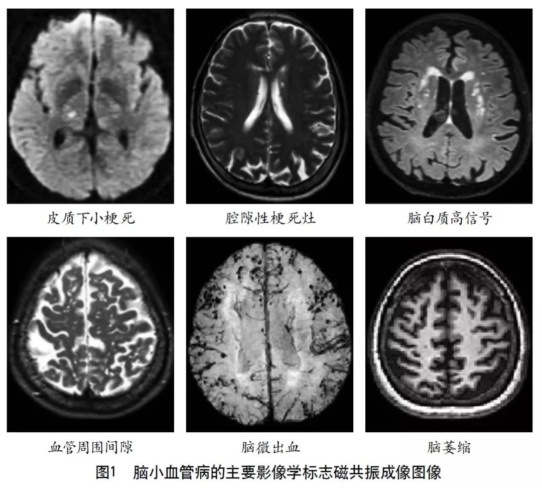 容易被误诊漏诊的脑小血管病,脑小血管病的基础知识