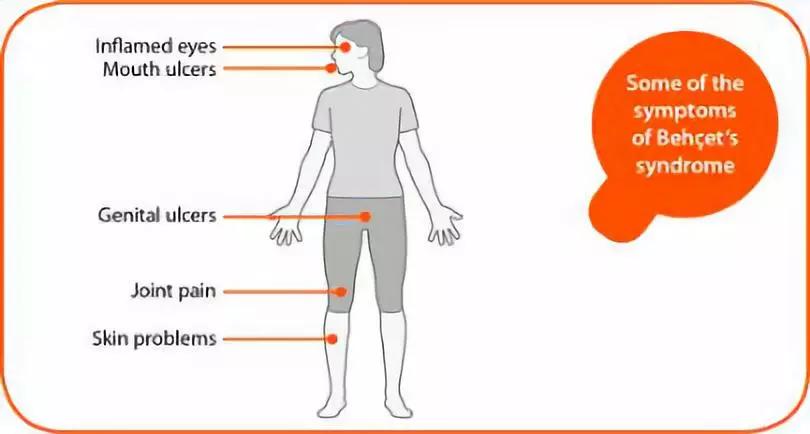 干细胞治疗的疾病及原理,瑞金医院白塞病干细胞移植