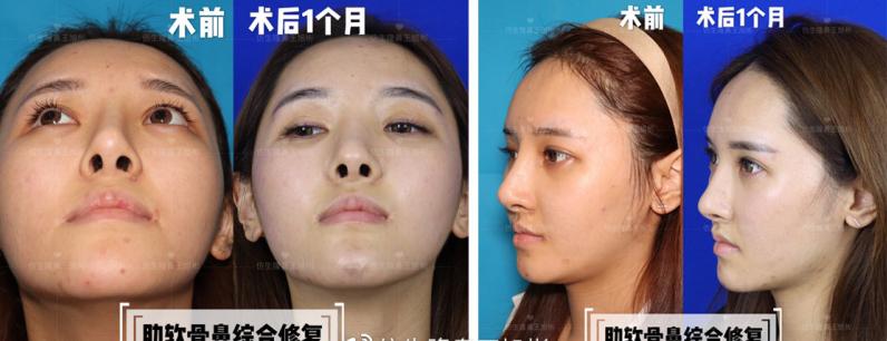 线雕隆鼻后鼻综合修复术,隆鼻失败修复手术真实案例