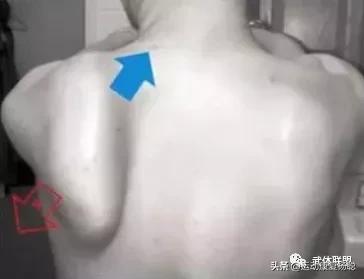 沉肩的时候肩胛骨下角翘起怎么办,肩胛骨翘起真的可以改善吗