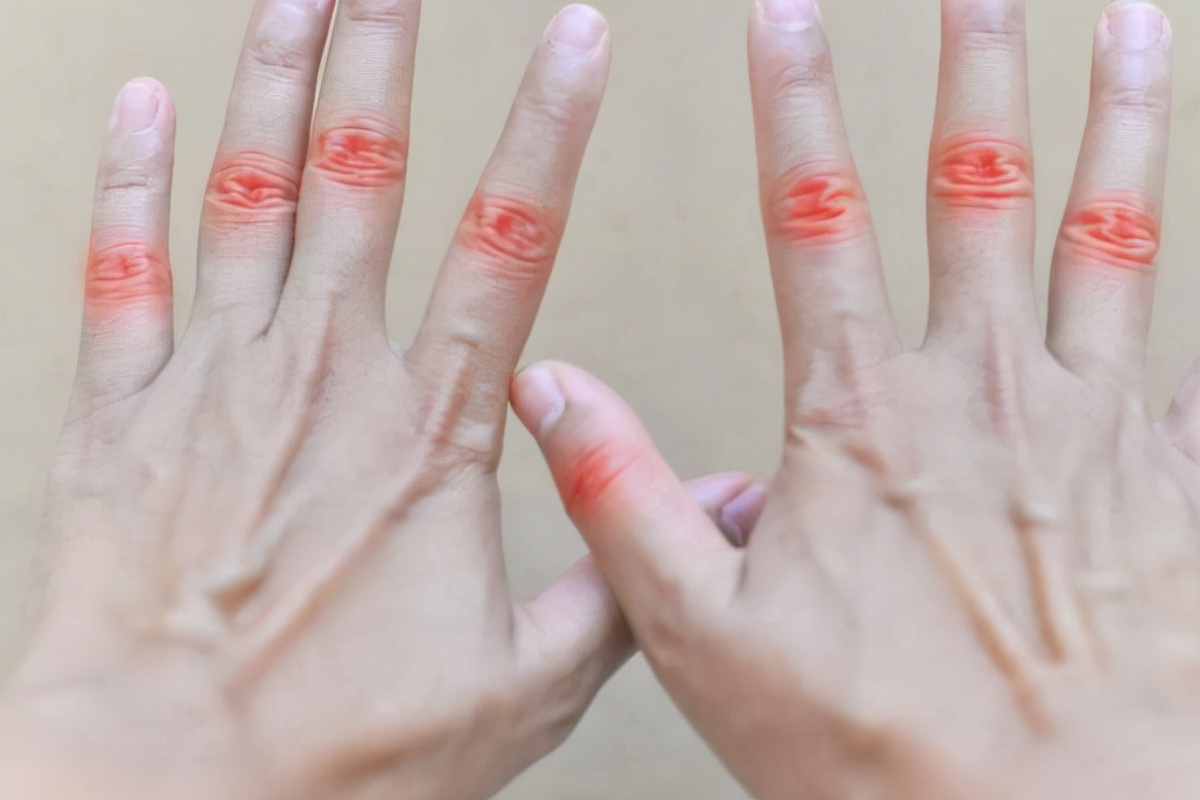 手指疼痛提示4种全身病变,手指关节疼痛多半是4种病导致