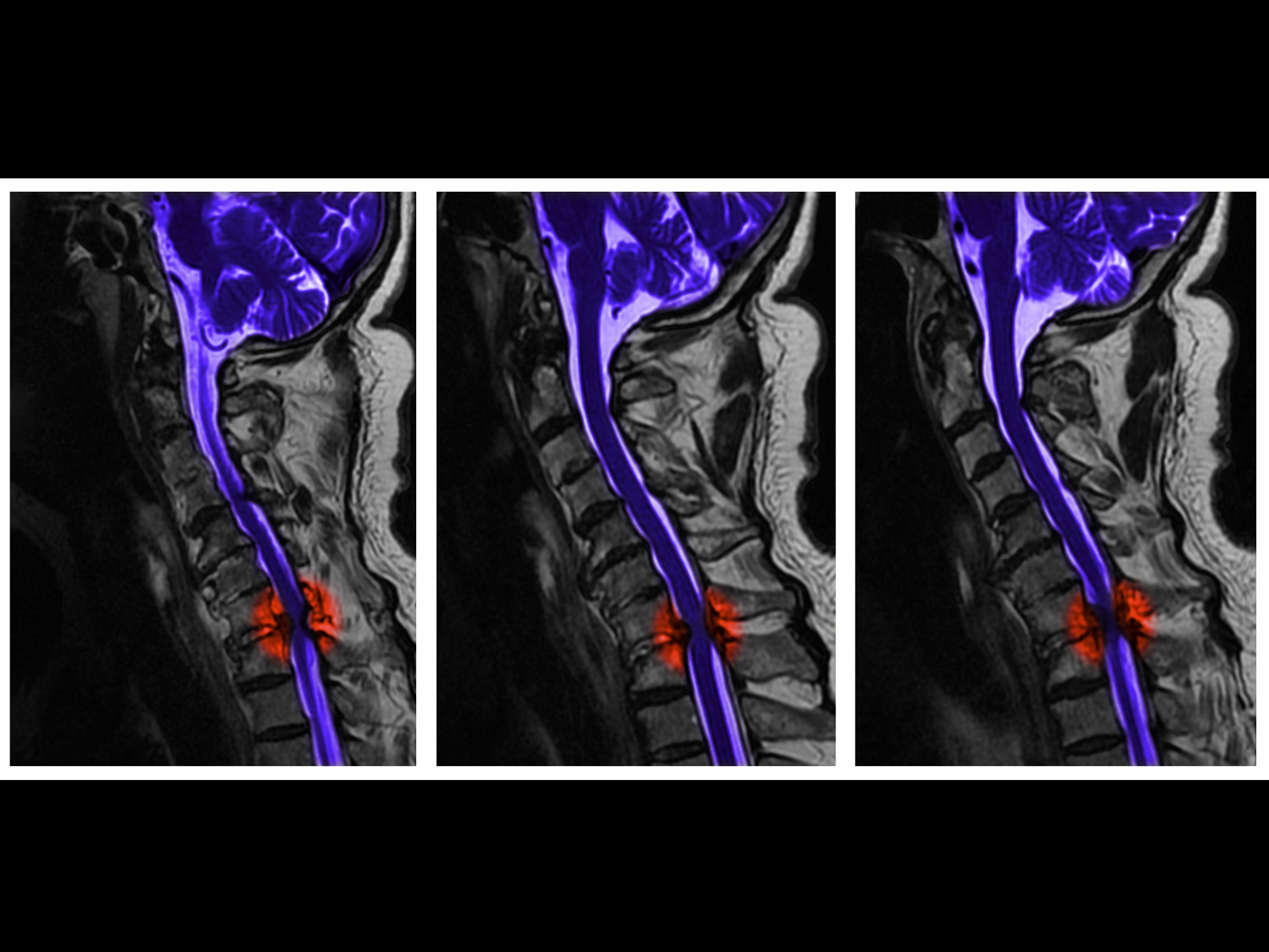 截瘫居家护理,截瘫患者照顾