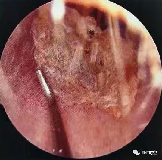 耳耵聍栓塞是什么原因引起的,耳科赵医生处理耵聍栓塞视频