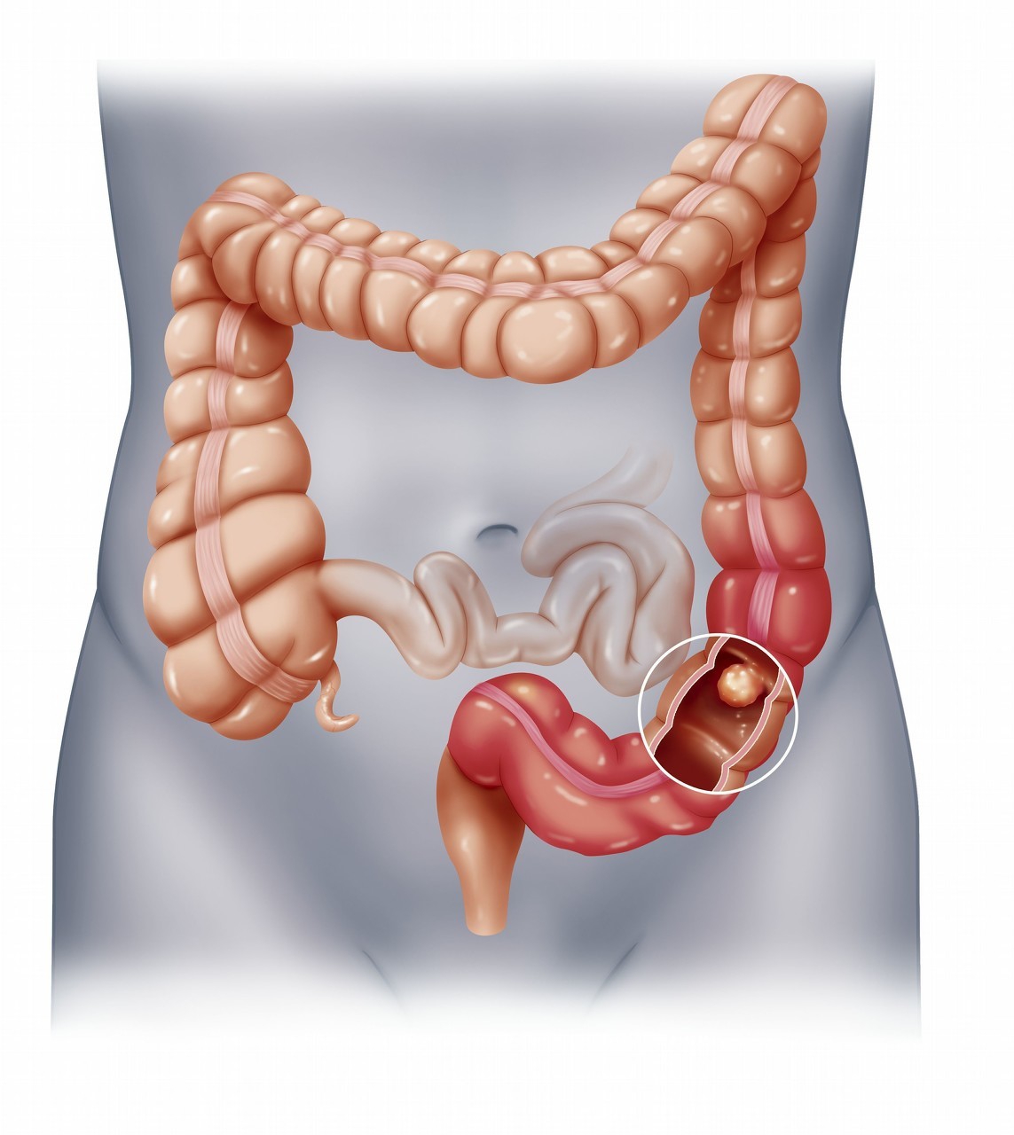 大肠癌科普知识（十二）浅谈肠造口的居家护理
