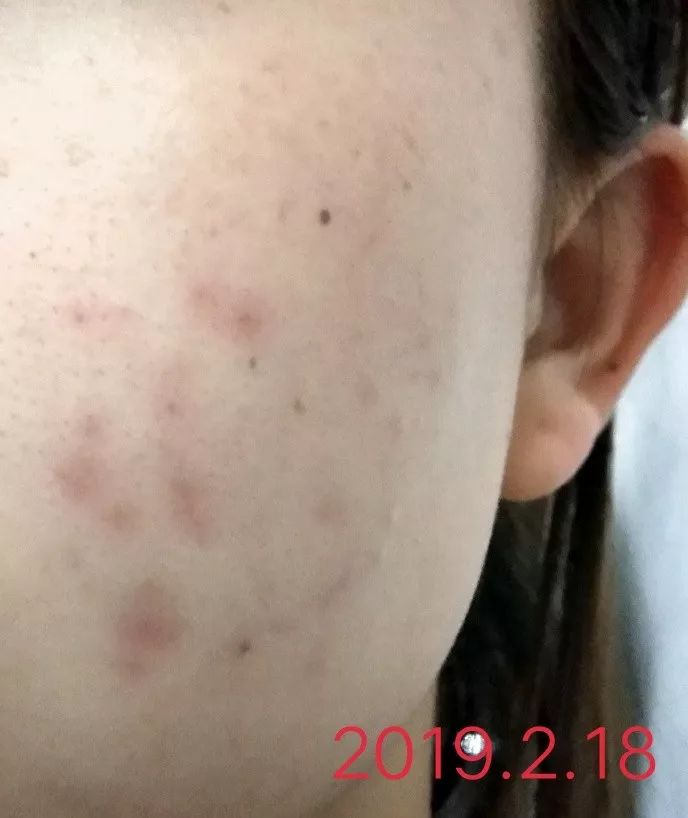 用了一款洗面奶之后脸上有痘痘,对于痘痘肌和黑痘印的洗面奶推荐