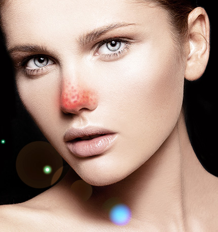 草莓鼻和无草莓鼻,最有效去除草莓鼻的方法