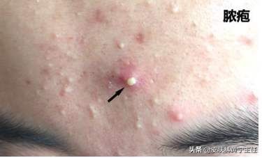 宅家的1个多月都没化妆，竟然还爆痘