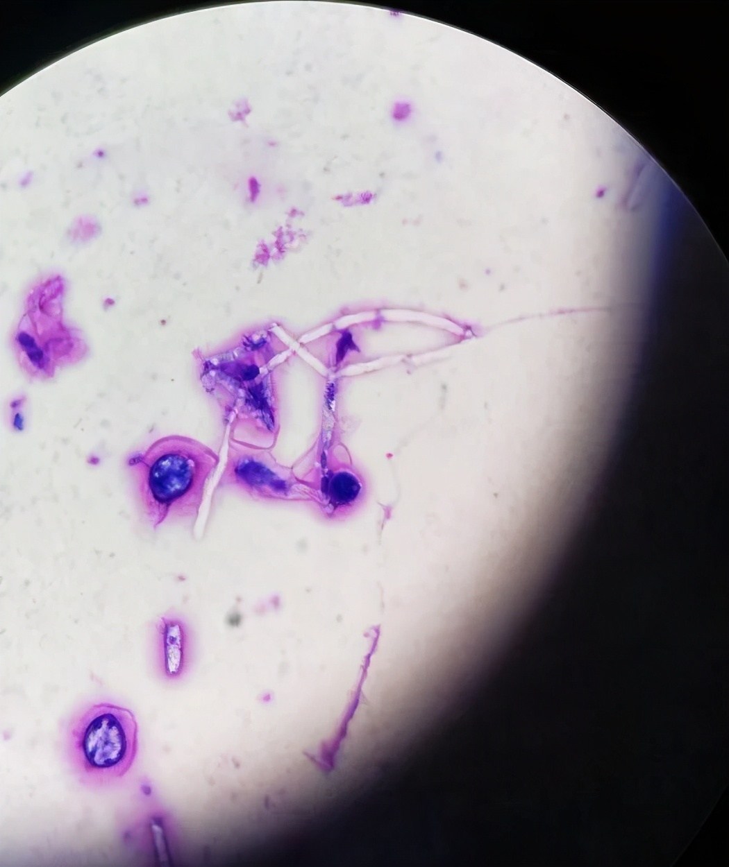 医生的恶魔，病人的死神！噬血细胞综合征来袭，生死边缘