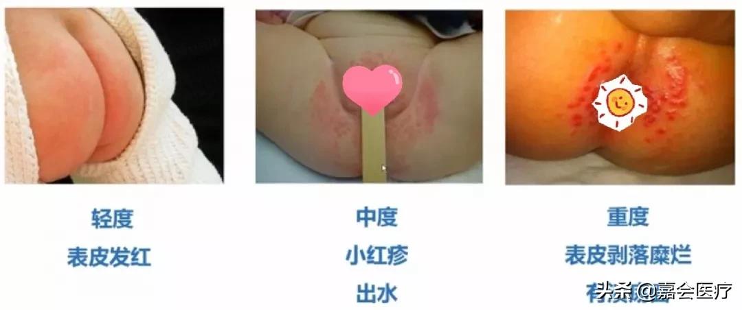 宝宝老是红屁股怎么办,宝宝红屁股怎么办最有效的方法