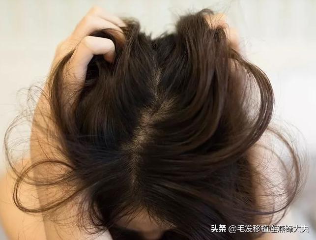 米诺地尔治疗男性脱发有效果吗,米诺地尔治疗脱发