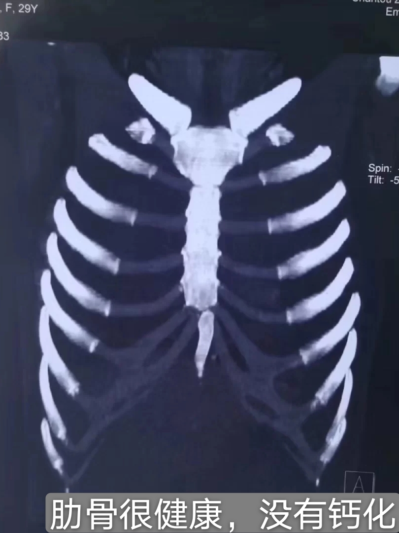 隆鼻怎么知道肋骨有没有钙化,肋骨钙化还能隆鼻吗