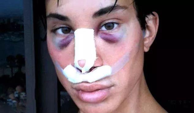 关于隆胸手术你想知道的那些事,隆胸丰臀整形