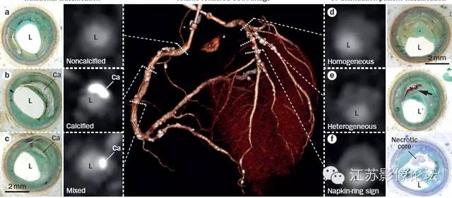 冠脉CT血管造影诊断高危斑块病变影像学特征分析