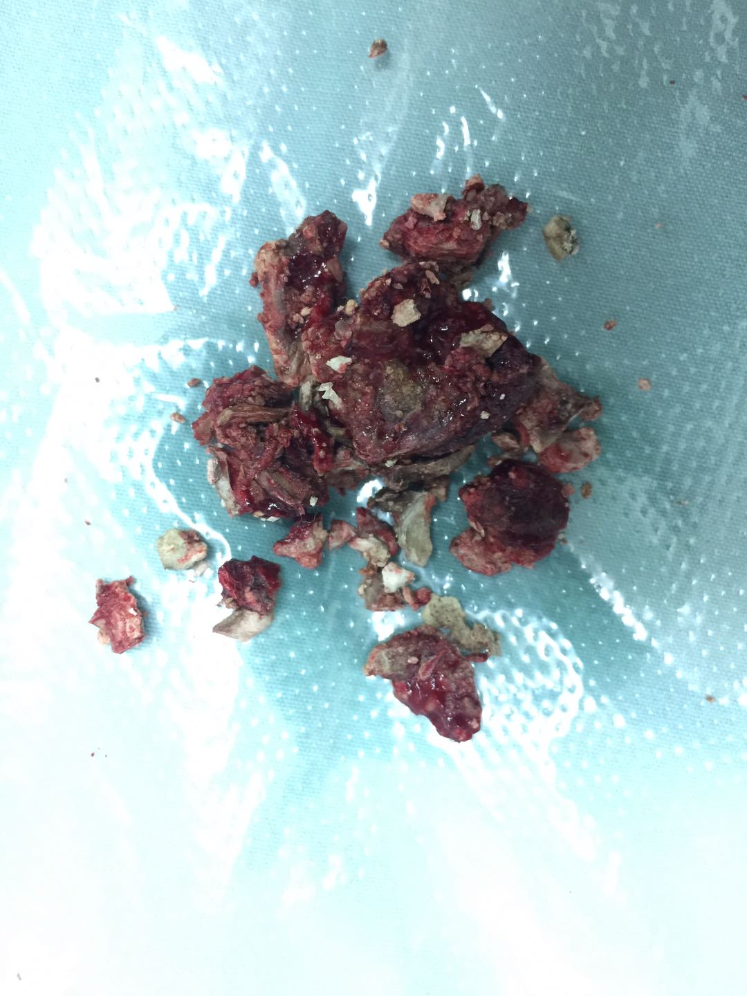 耳鼻喉科完成我院首例鼻内镜下巨大鼻石取出术