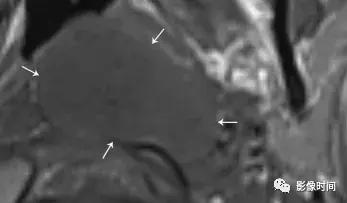 双侧颈动脉鞘间隙多发小淋巴结影,双侧颈动脉间隙多软组织密度结节