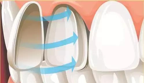 Helen齿科中心——全瓷贴面高科技“美容每一颗牙齿”