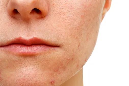 辟谣、吃酱油加深痘印？芦荟胶治好痘坑？别傻了！