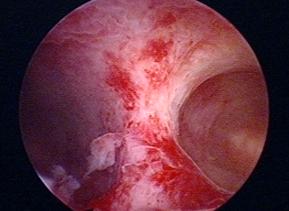 子宫偏小不治疗怀孕容易流产,子宫偏小容易流产怎么办