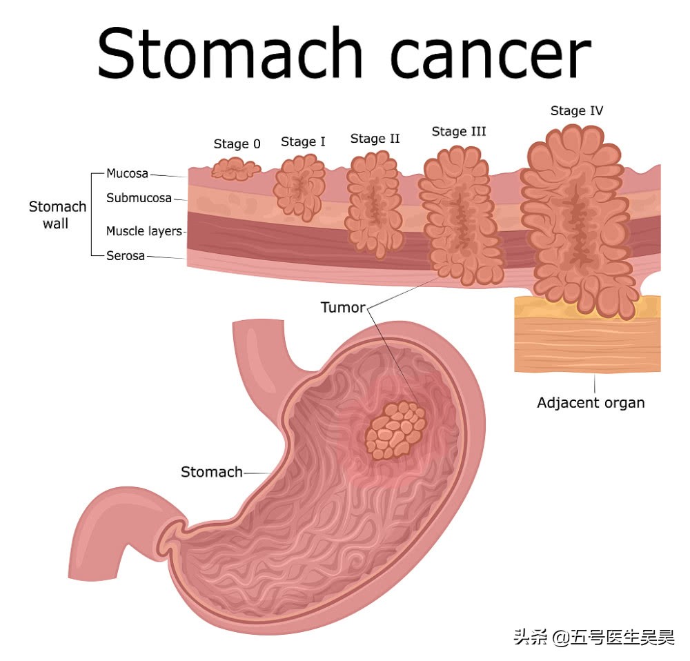 无痛胃镜检查前的准备和注意事项,无痛肠胃镜做之前需要注意什么