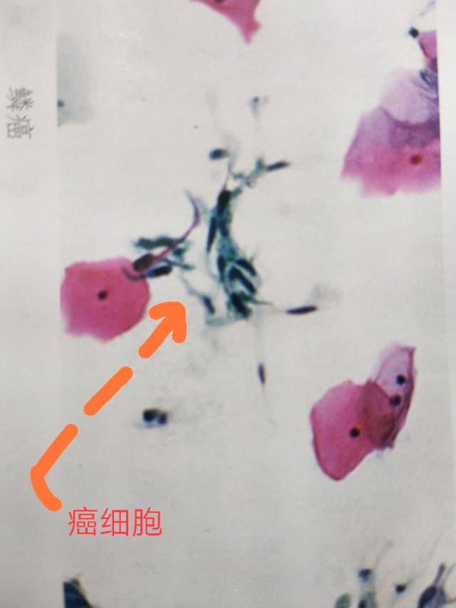 女性hpv感染会传染男的吗,女性hpv感染会不会痒