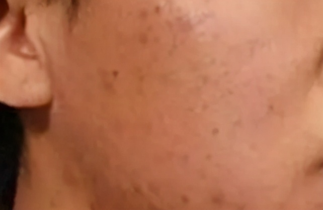 去除疮疤的最好方法,疮疤去除