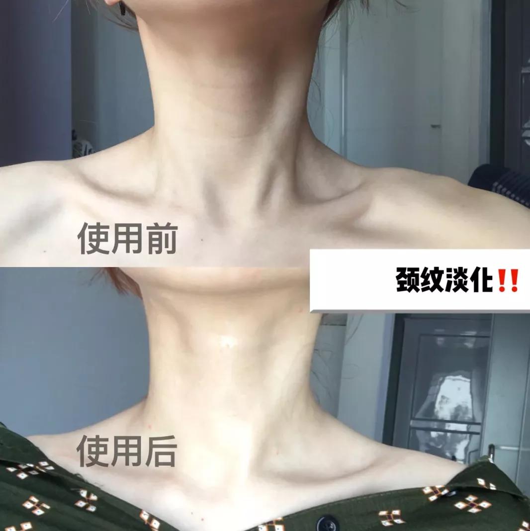 有颈纹和没有颈纹的女人,女人有颈纹怎么办