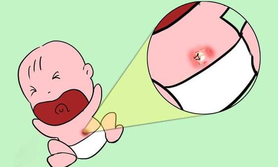 新生儿肚脐眼怎么消毒擦拭,婴儿肚脐眼需要消毒吗