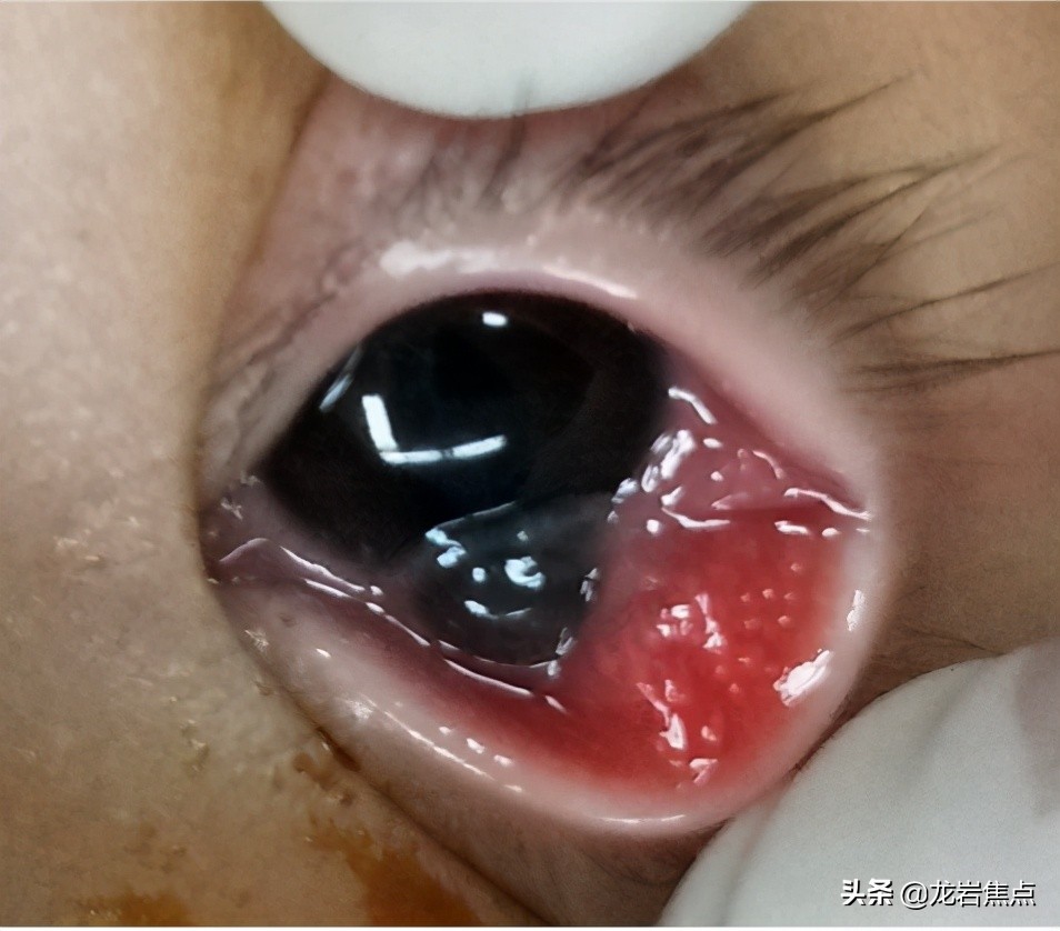 一岁小孩被公鸡啄伤后发生的事,男童被鸡啄伤