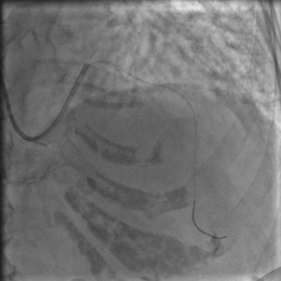 85岁老人心脏堵塞,77岁老人冠脉狭窄放支架还是搭桥