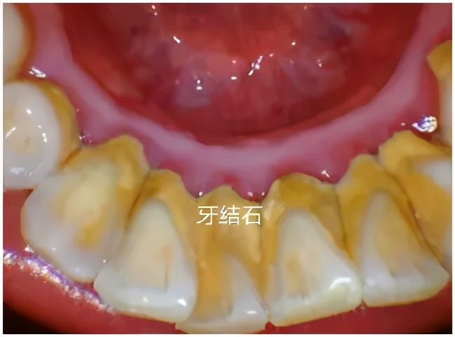牙结石是每个人都会有的吗,牙结石是每个人都会有的嘛