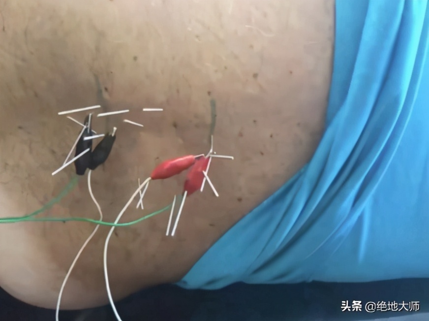 膝关节术后慢性疼痛神经调控康复方案