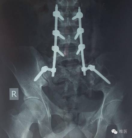 腰椎压缩性骨折保守治疗畸形愈合,骨折或关节脱位的急救处理