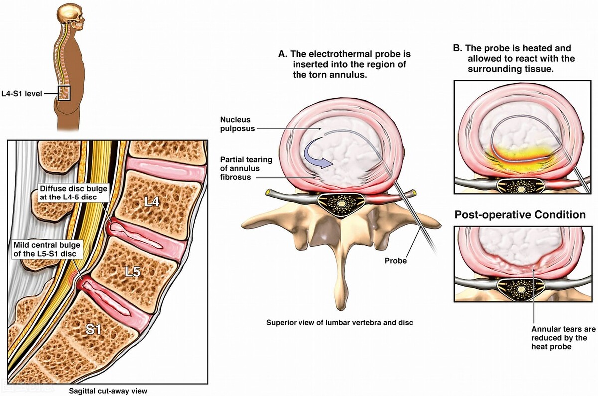 腰椎间盘突出打臭氧针属于微创吗,腰椎间盘突出臭氧还是射频效果好