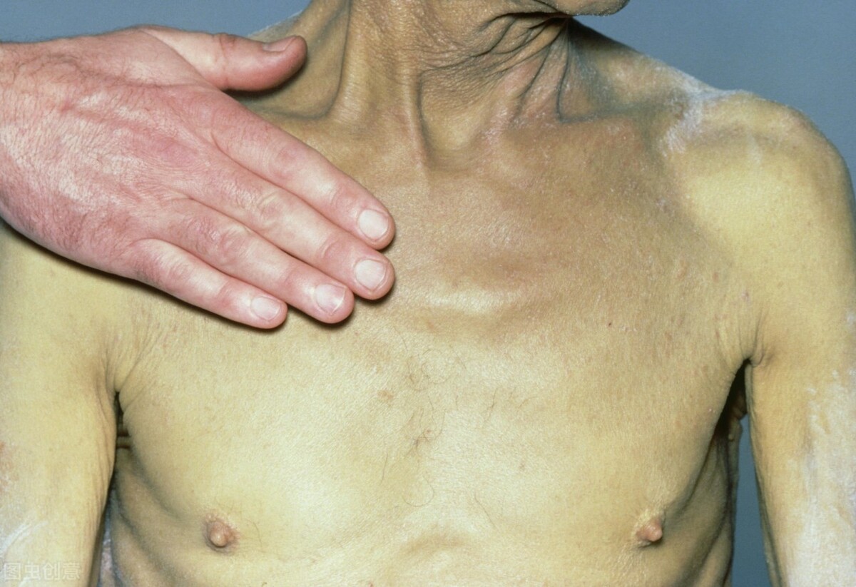 转氨酶胆红素都高伴有黄疸严重吗,转氨酶高必须要吃保肝药吗