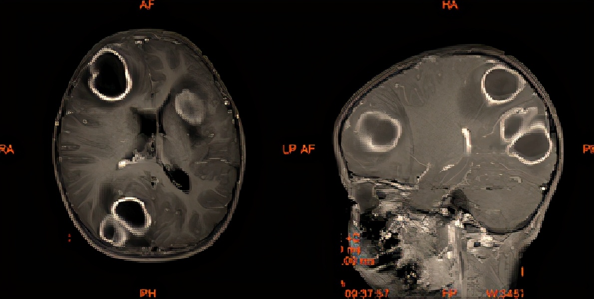 脑脓肿反复发烧怎么办,15岁男孩检查出脑脓肿