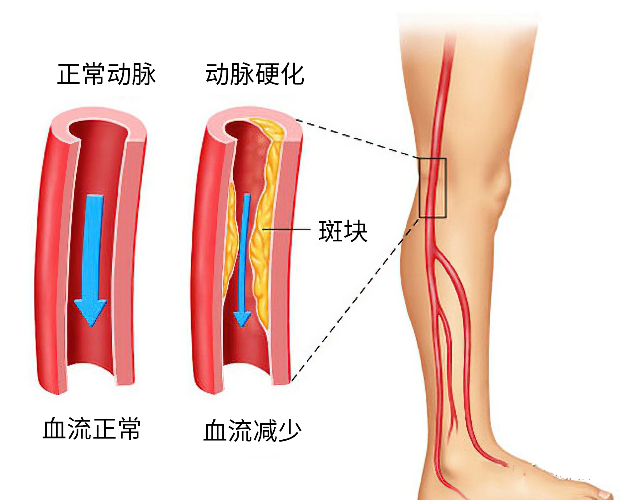 老年人关节病想置换人工关节，又担心副作用，该怎么办？