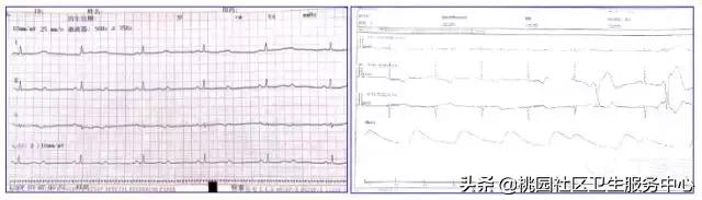 早期心梗心电图能查出来吗,警惕这种要命的心电图表现