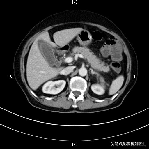 暴饮暴食导致胃脘胀满疼痛,暴饮暴食引起的腹部疼痛怎么缓解