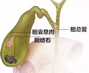 息肉演变的癌能治吗,息肉癌变的原因和治疗方法