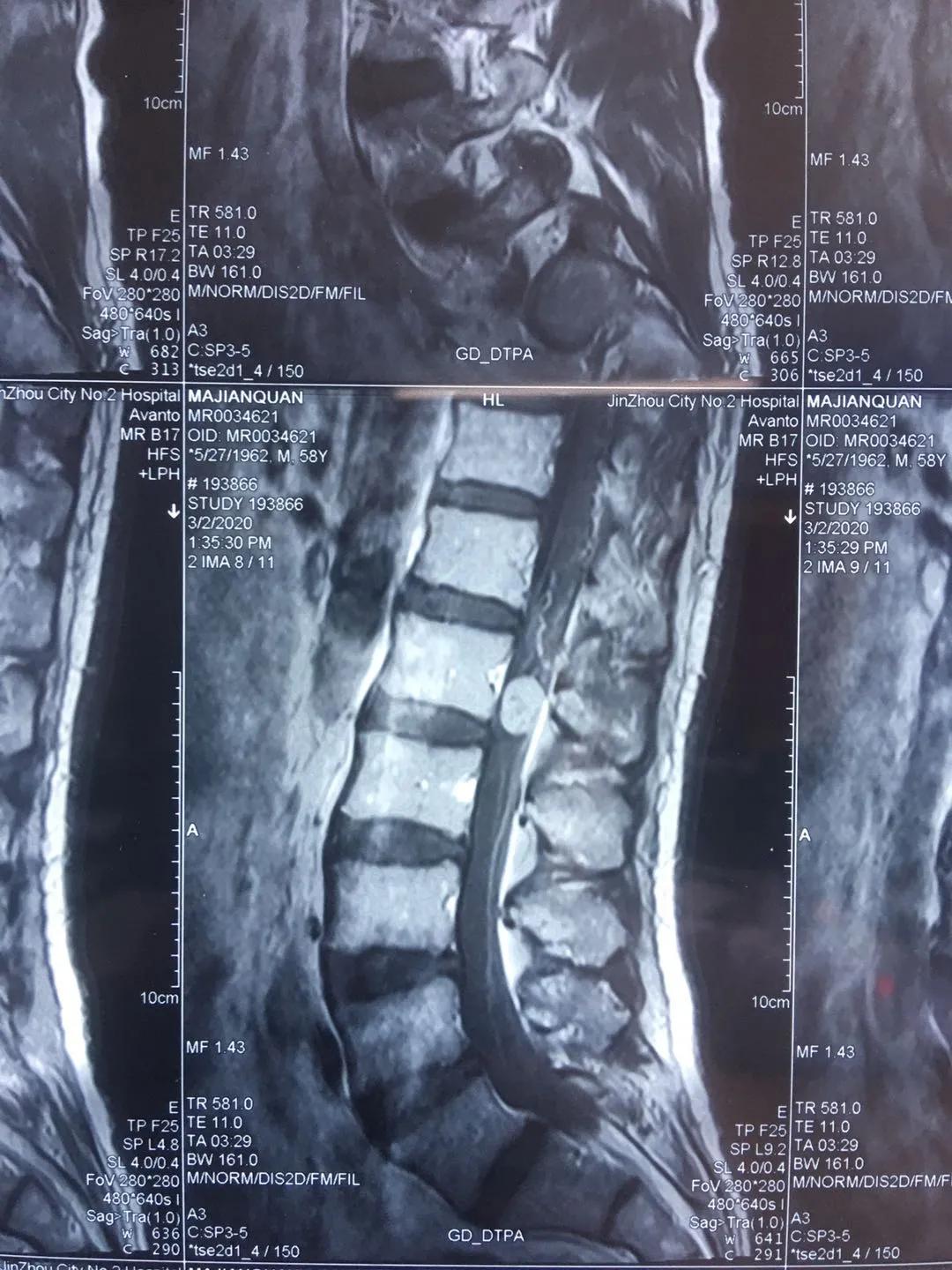 椎管内肿瘤辽宁省肿瘤医院能治吗,椎管内肿瘤手术做得好的医院